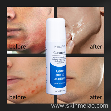 Reduces Delicate And Smooth Razor Bumps Solution